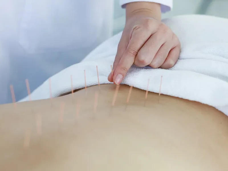 Acupuncture physical therapy at Midtown East Physical Therapy in New York, NY